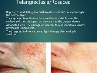 Telangiectasia/Rosacea
• Represents undulating dilated dermal vessels that course through
the dermal layer.
• They appear discontinuous because they are visible near the
surface and then disappear as they are into the deeper dermis.
• Associated with U/V damage or rosacea, they respond to a variety
of vascular lesion lasers.
• They respond to Intense pulsed light therapy after multiple
sessions.
 