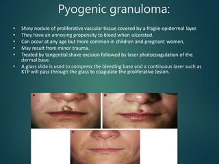 Pyogenic granuloma:
• Shiny nodule of proliferative vascular tissue covered by a fragile epidermal layer.
• They have an annoying propensity to bleed when ulcerated.
• Can occur at any age but more common in children and pregnant women.
• May result from minor trauma.
• Treated by tangential shave excision followed by laser photocoagulation of the
dermal base.
• A glass slide is used to compress the bleeding base and a continuous laser such as
KTP will pass through the glass to coagulate the proliferative lesion.
 
