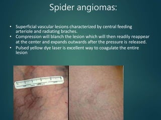 Spider angiomas:
• Superficial vascular lesions characterized by central feeding
arteriole and radiating braches.
• Compression will blanch the lesion which will then readily reappear
at the center and expands outwards after the pressure is released.
• Pulsed yellow dye laser is excellent way to coagulate the entire
lesion
 