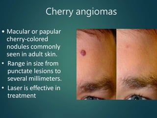 Cherry angiomas
• Macular or papular
cherry-colored
nodules commonly
seen in adult skin.
• Range in size from
punctate lesions to
several millimeters.
• Laser is effective in
treatment
 