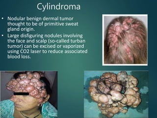 Cylindroma
• Nodular benign dermal tumor
thought to be of primitive sweat
gland origin.
• Large disfiguring nodules involving
the face and scalp (so-called turban
tumor) can be excised or vaporized
using CO2 laser to reduce associated
blood loss.
 