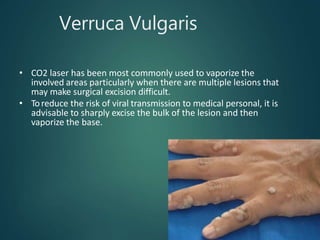 Verruca Vulgaris
• CO2 laser has been most commonly used to vaporize the
involved areas particularly when there are multiple lesions that
may make surgical excision difficult.
• Toreduce the risk of viral transmission to medical personal, it is
advisable to sharply excise the bulk of the lesion and then
vaporize the base.
 