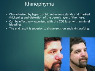 Rhinophyma
• Characterized by hypertrophic sebaceous glands and marked
thickening and distortion of the dermis layer of the nose.
• Can be effectively vaporized with the CO2 laser with minimal
bleeding.
• The end result is superior to shave excision and skin grafting.
 