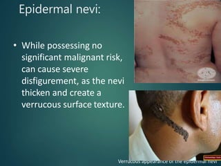 Epidermal nevi:
• While possessing no
significant malignant risk,
can cause severe
disfigurement, as the nevi
thicken and create a
verrucous surface texture.
Verrucous appearance of the epidermal nevi
 