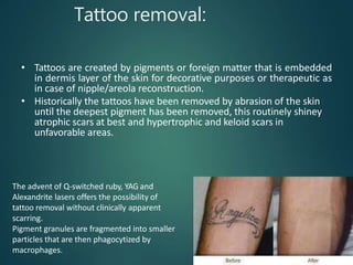 Tattoo removal:
• Tattoos are created by pigments or foreign matter that is embedded
in dermis layer of the skin for decorative purposes or therapeutic as
in case of nipple/areola reconstruction.
• Historically the tattoos have been removed by abrasion of the skin
until the deepest pigment has been removed, this routinely shiney
atrophic scars at best and hypertrophic and keloid scars in
unfavorable areas.
The advent of Q-switched ruby, YAG and
Alexandrite lasers offers the possibility of
tattoo removal without clinically apparent
scarring.
Pigment granules are fragmented into smaller
particles that are then phagocytized by
macrophages.
 