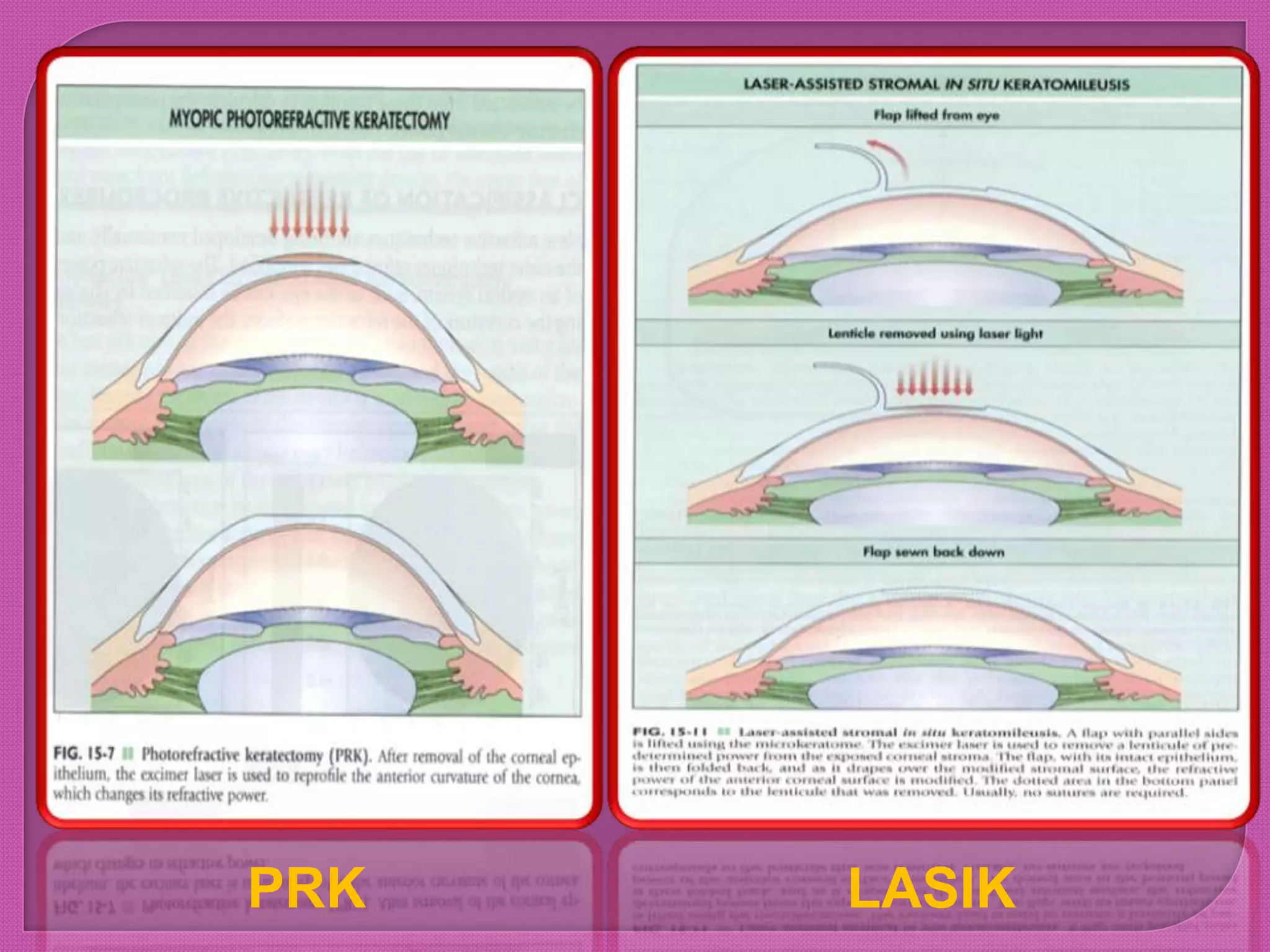 PRK LASIK
 