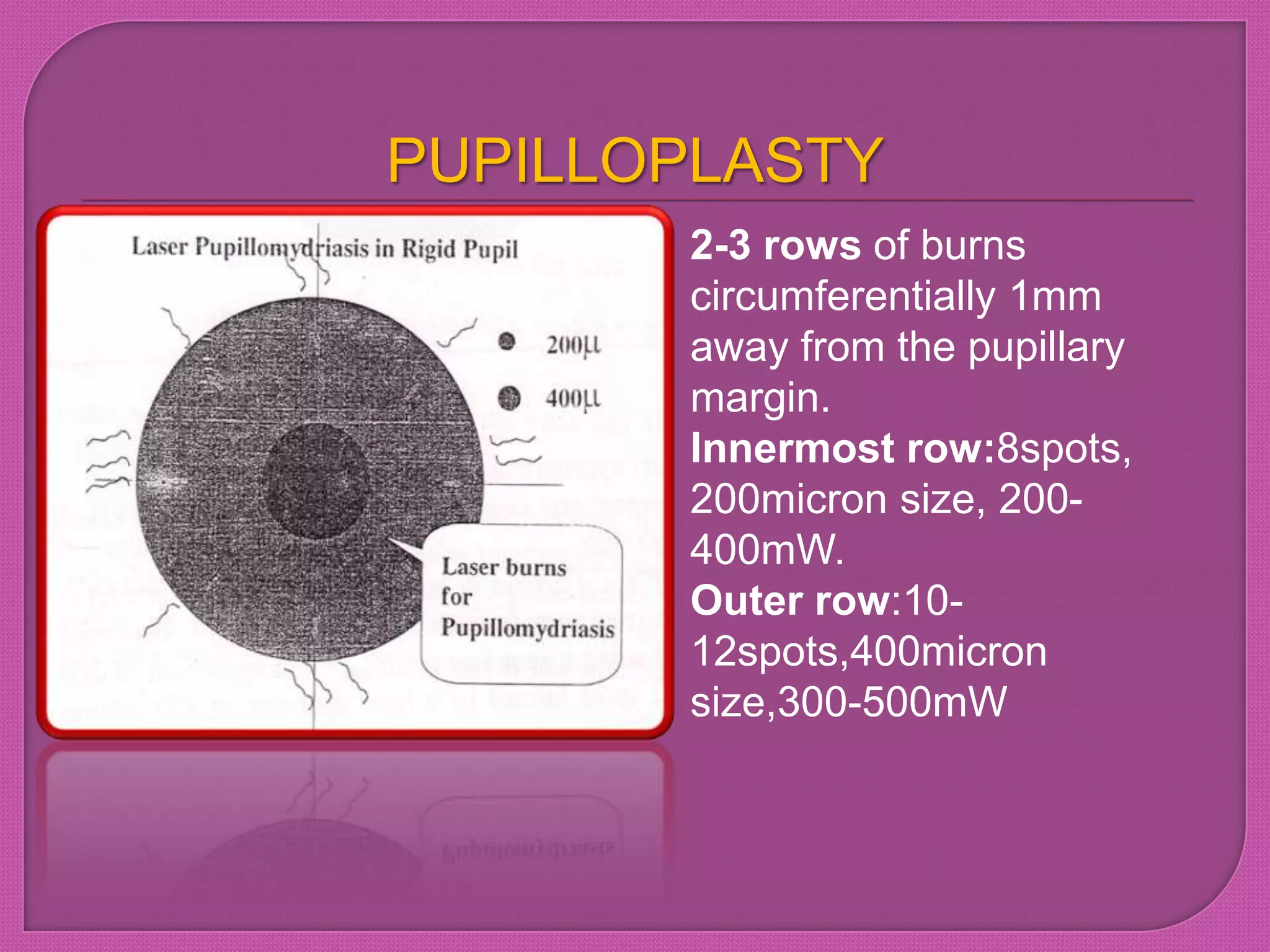 PUPILLOPLASTY
2-3 rows of burns
circumferentially 1mm
away from the pupillary
margin.
Innermost row:8spots,
200micron size, 200-
400mW.
Outer row:10-
12spots,400micron
size,300-500mW
 