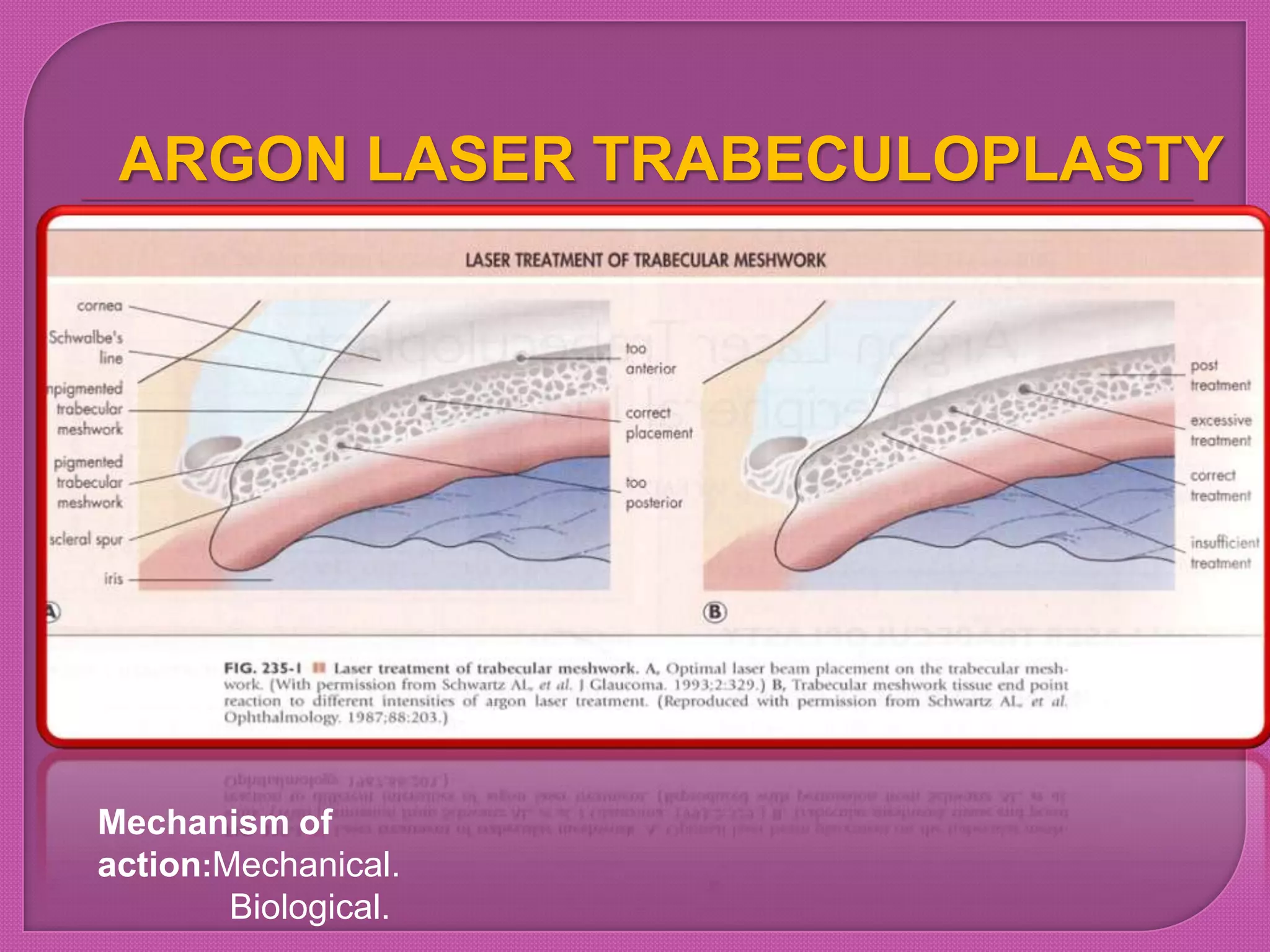 ARGON LASER TRABECULOPLASTY
Mechanism of
action:Mechanical.
Biological.
 