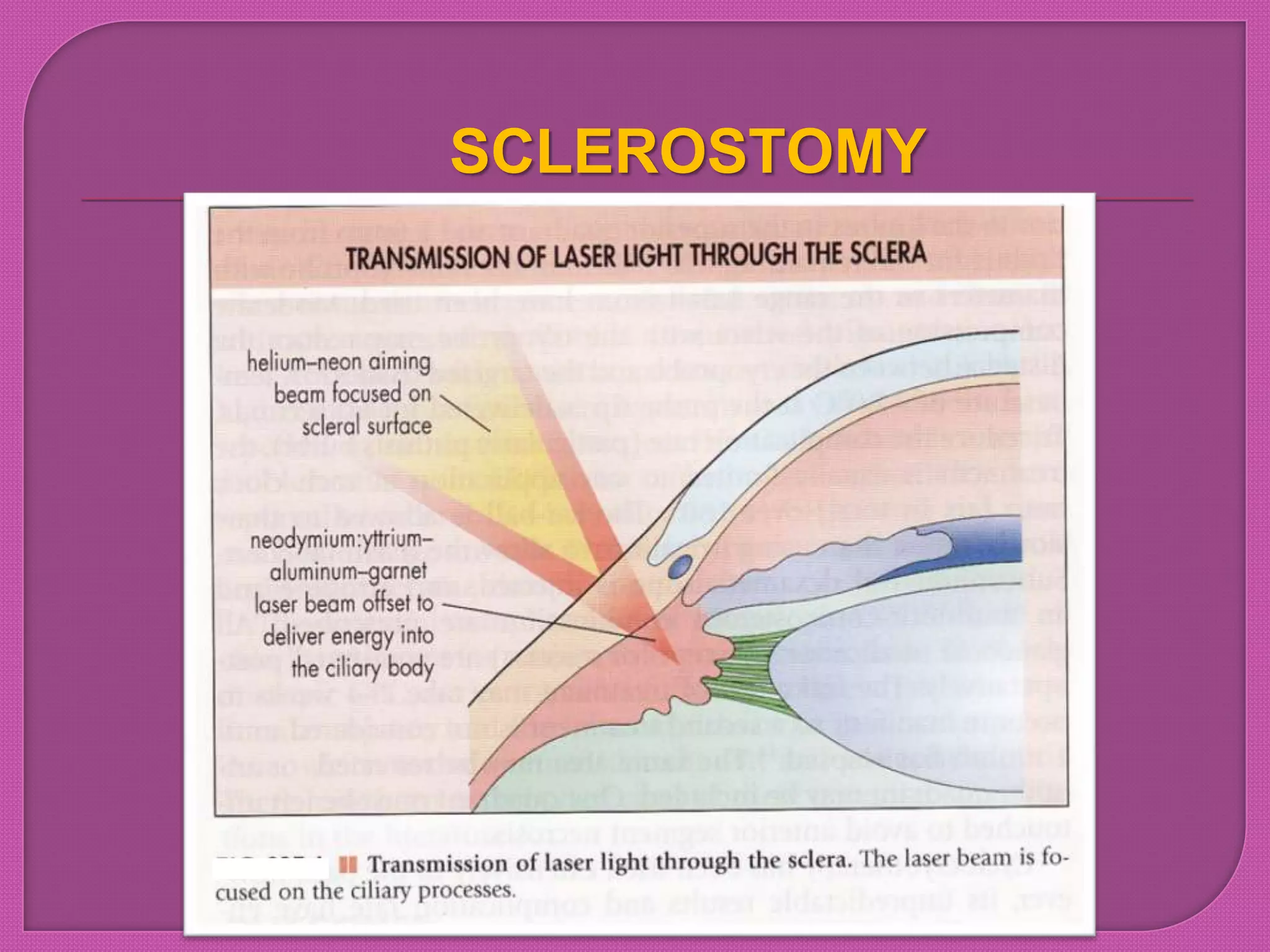 SCLEROSTOMY
 