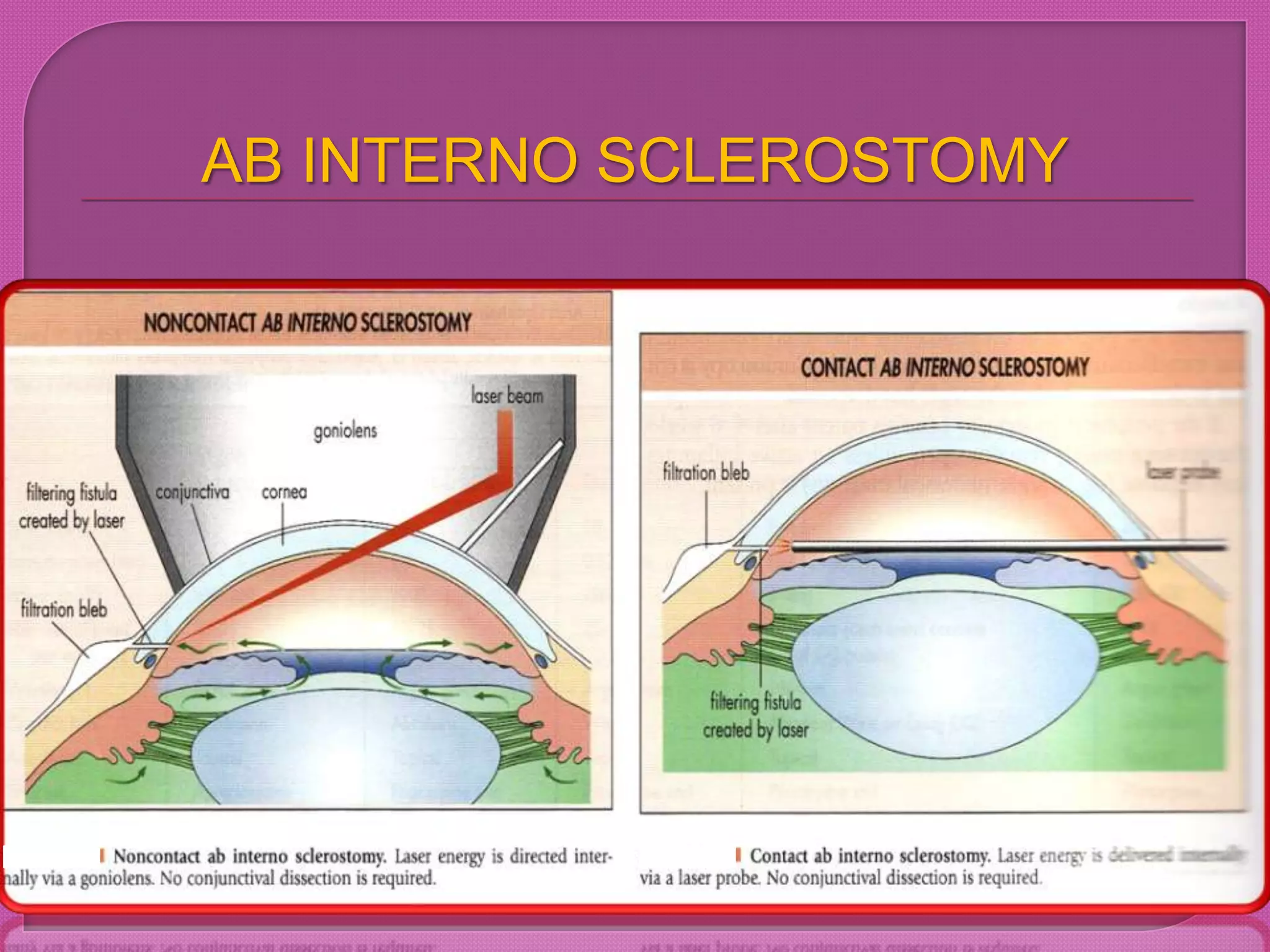 AB INTERNO SCLEROSTOMY
 