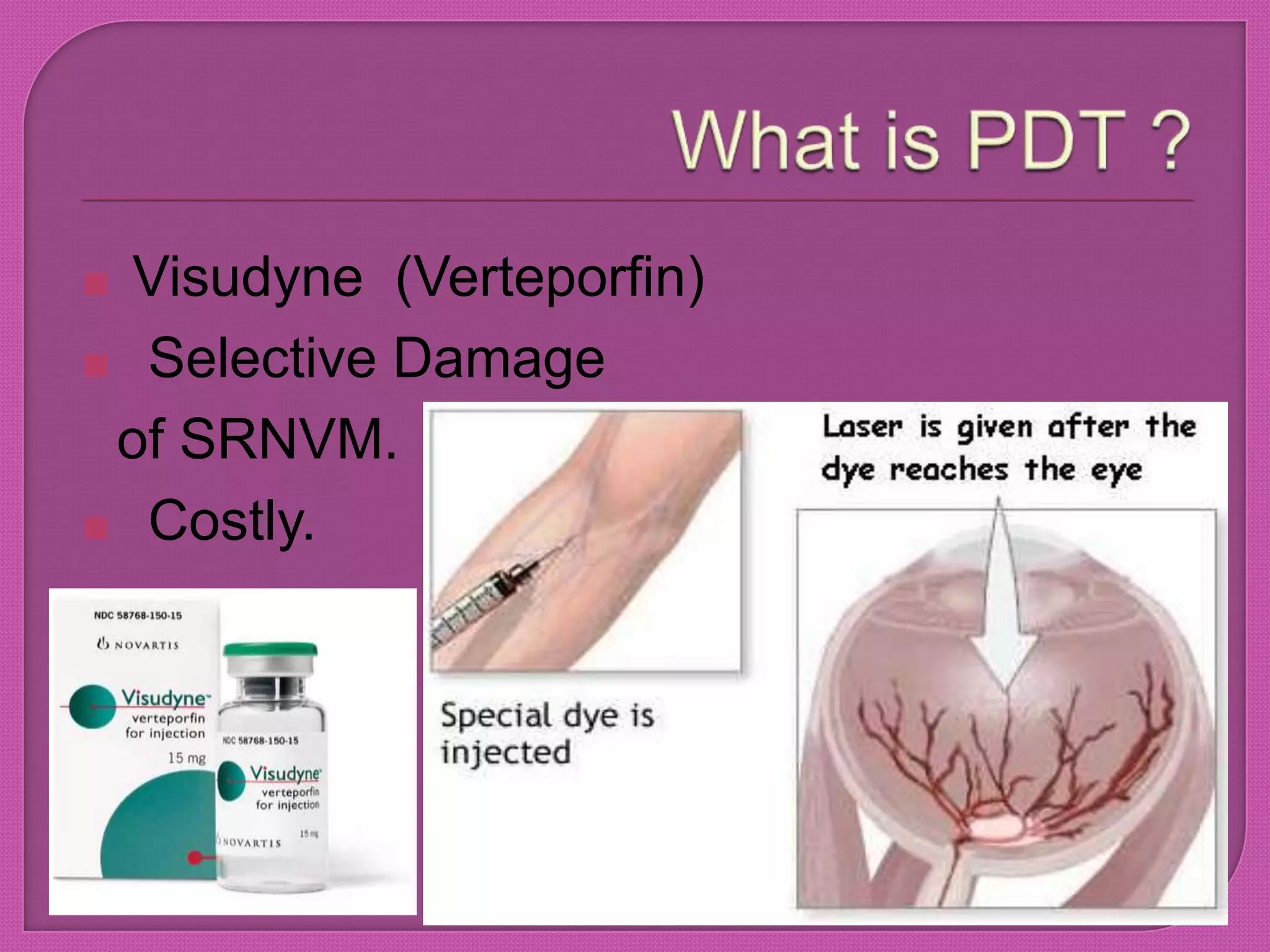  Visudyne (Verteporfin)
 Selective Damage
of SRNVM.
 Costly.
 