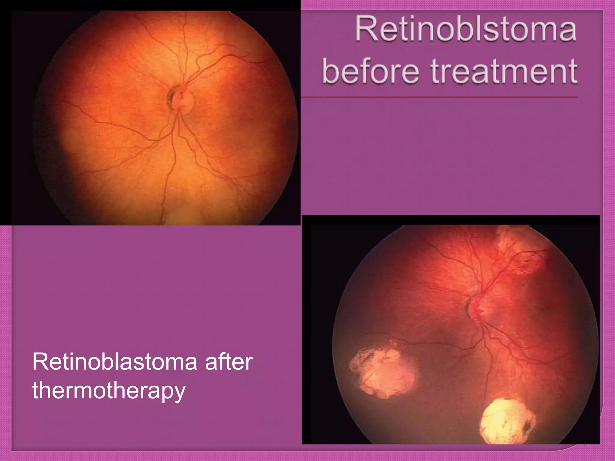 Retinoblastoma after
thermotherapy
 