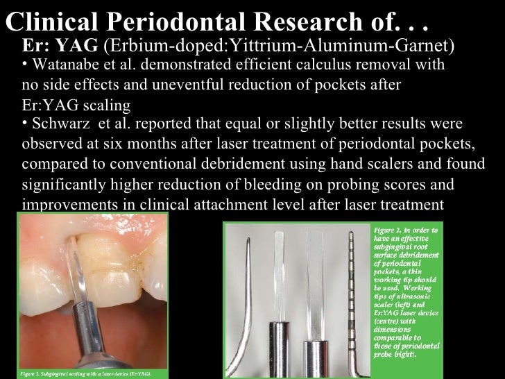 Lasers In Dental Hygiene Powerpoint
