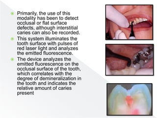  Primarily, the use of this
modality has been to detect
occlusal or flat surface
defects, although interstitial
caries can also be recorded.
 This system illuminates the
tooth surface with pulses of
red laser light and analyzes
the emitted fluorescence.
 The device analyzes the
emitted fluorescence on the
occlusal surface of the tooth,
which correlates with the
degree of demineralization in
the tooth and indicates the
relative amount of caries
present
 