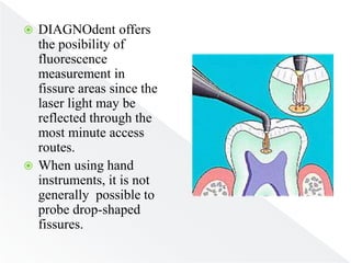  DIAGNOdent offers
the posibility of
fluorescence
measurement in
fissure areas since the
laser light may be
reflected through the
most minute access
routes.
 When using hand
instruments, it is not
generally possible to
probe drop-shaped
fissures.
 