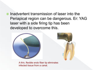  Inadvertent transmission of laser into the
Periapical region can be dangerous. Er: YAG
laser with a side firing tip has been
developed to overcome this.
A thin, flexible endo fiber tip eliminates
infected tissue from a canal.
 
