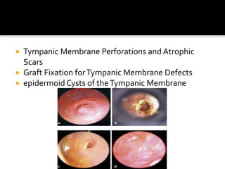  Tympanic Membrane Perforations and Atrophic
Scars
 Graft Fixation forTympanic Membrane Defects
 epidermoid Cysts of theTympanic Membrane
 