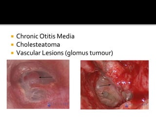  Chronic Otitis Media
 Cholesteatoma
 Vascular Lesions (glomus tumour)
 