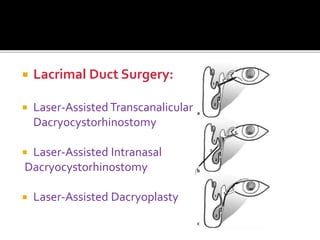  Lacrimal Duct Surgery:
 Laser-Assisted Transcanalicular
Dacryocystorhinostomy
 Laser-Assisted Intranasal
Dacryocystorhinostomy
 Laser-Assisted Dacryoplasty
 
