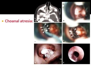  Choanal atresia:
 