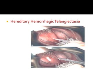  Hereditary HemorrhagicTelangiectasia
 