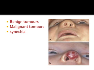  Benign tumours
 Malignant tumours
 synechia
 