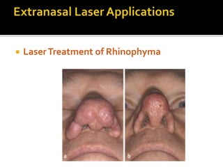  LaserTreatment of Rhinophyma
 