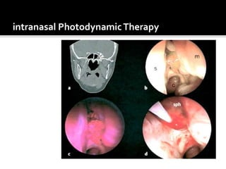 intranasal PhotodynamicTherapy
 