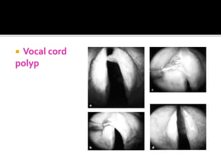  Vocal cord
polyp
 