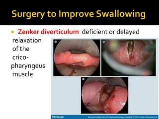 Zenker diverticulum deficient or delayed
relaxation
of the
crico-
pharyngeus
muscle
 