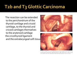The resection can be extended
to the perichondrium of the
thyroid cartilage and cricoid
cartilage, to the thyroid and
cricoid cartilages themselves
to the arytenoid cartilage
the cricothyroid ligament
and the extralaryngeal soft tissues
 