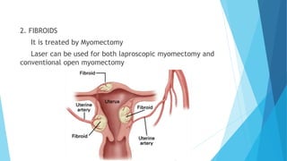 2. FIBROIDS
It is treated by Myomectomy
Laser can be used for both laproscopic myomectomy and
conventional open myomectomy
 