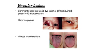 • Commonly used is pulsed dye laser at 580 nm &short
pulses 450 microseconds
• Haemangiomas
• Venous malformations
Vascular lesions
 