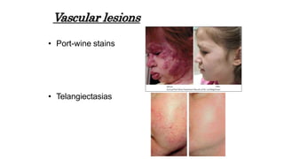 Vascular lesions
• Port-wine stains
• Telangiectasias
 
