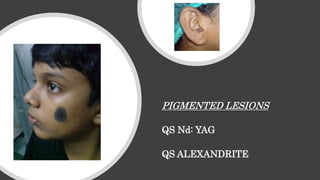 PIGMENTED LESIONS
QS Nd: YAG
QS ALEXANDRITE
 
