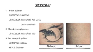 TATTOOS
1. Black pigment
QS Nd:YAG (1046NM)
QS ALEXANDRITE (755 NM Versa
pulse coherent)
2. Blue & green pigments
QS ALEXANDRITE (755 nm)
3. Red, orange & yellow
QS Nd:YAG (532nm)
FPPDL (510nm)
 