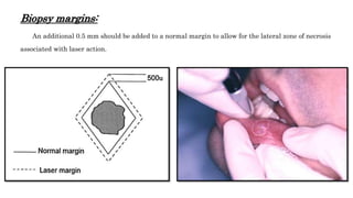 Biopsy margins:
An additional 0.5 mm should be added to a normal margin to allow for the lateral zone of necrosis
associated with laser action.
 