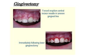 Gingivectomy
 