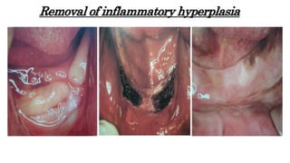 Removal of inflammatory hyperplasia
 