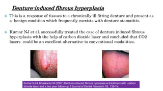 Denture-induced fibrous hyperplasia
 This is a response of tissues to a chronically ill fitting denture and present as
a benign condition which frequently coexists with denture stomatitis.
 Kumar NJ et al. successfully treated the case of denture induced fibrous
hyperplasia with the help of carbon dioxide laser and concluded that CO2
lasers could be an excellent alternative to conventional modalities.
Kumar NJ & Bhaskaran M (2007) Denture-induced fibrous hyperplas-ia:treatment with carbon
dioxide laser and a two year follow-up. I Journal of Dental Research 18, 135-7e.
 