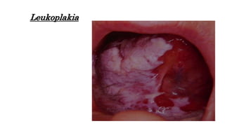 Leukoplakia
 