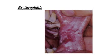 Erythroplakia
 