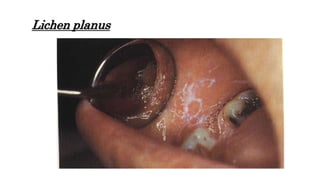 Lichen planus
 