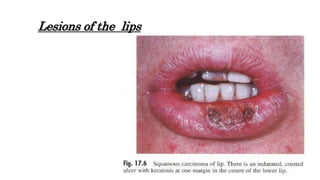 Lesions of the lips
 