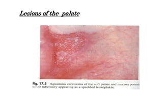 Lesions of the palate
 