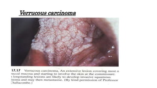 Verrucous carcinoma
 