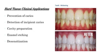Hard Tissue Clinical Applications
 Prevention of caries
 Detection of incipient caries
 Cavity preparation
 Enamel etching
 Desensitization
 