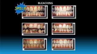 BLEACHING
SMILE
 