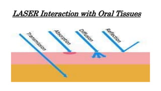 LASER Interaction with Oral Tissues
 