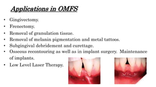 Applications in OMFS
• Gingivectomy.
• Frenectomy.
• Removal of granulation tissue.
• Removal of melanin pigmentation and metal tattoos.
• Subgingival debridement and curettage.
• Osseous recontouring as well as in implant surgery. Maintenance
of implants.
• Low Level Laser Therapy.
 